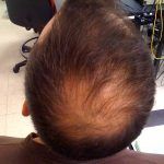 Alopezie