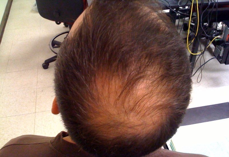 Alopezie