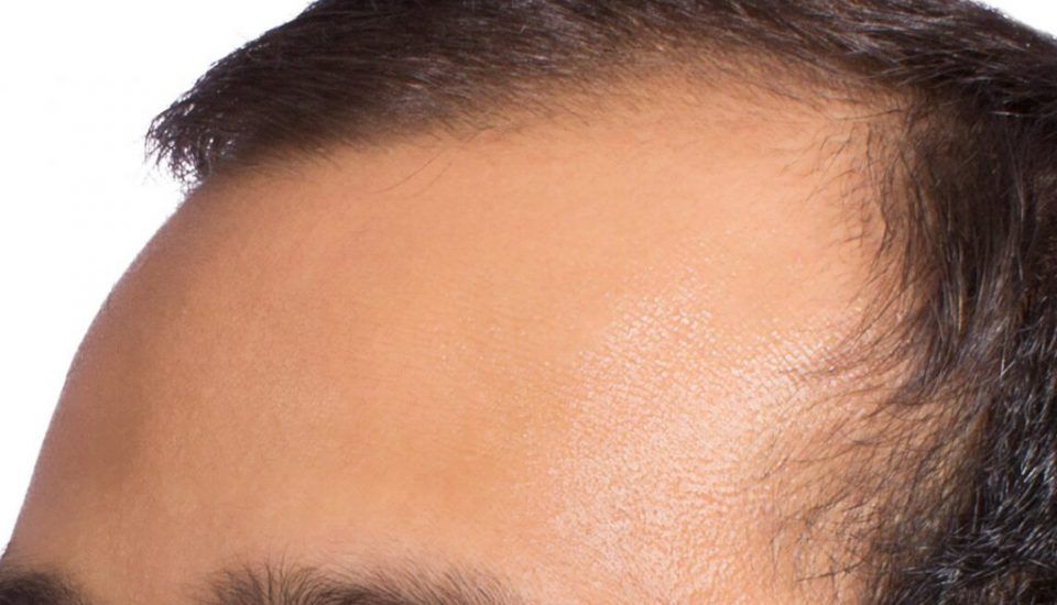 vor während Haartransplantation