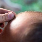 tipps Haartransplantation