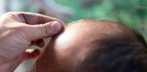 tipps Haartransplantation