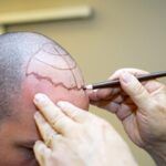 berühmte Persönlichkeiten Haartransplantation
