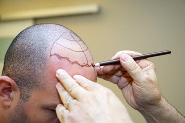 berühmte Persönlichkeiten Haartransplantation