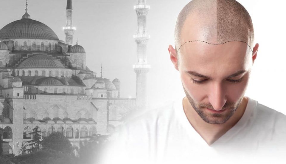 Haartransplantation