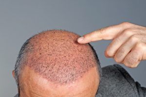 Kapillarimplantat