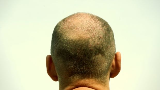 Wieso hört das Haar auf zu wachsen- haartransplantation