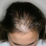 Natürliche Hausmittel gegen Haarausfall