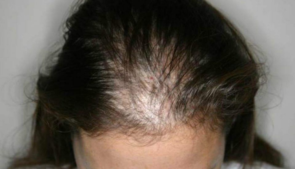 Natürliche Hausmittel gegen Haarausfall