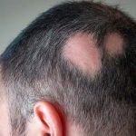 Alopezie Areata Behandlung Kahlheit