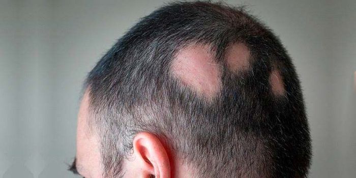 Alopezie Areata Behandlung Kahlheit