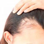 Lösung gegen Haarausfall