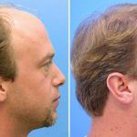 Haartransplantation Barcelona