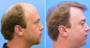 Haartransplantation Barcelona