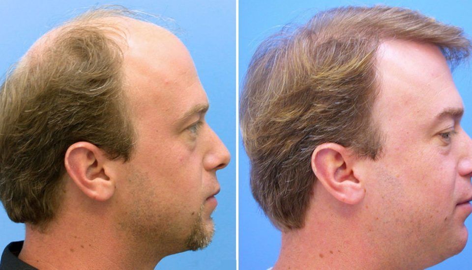 Haartransplantation Barcelona