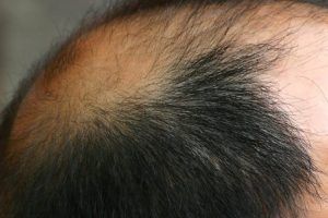FUE-Haartransplantation