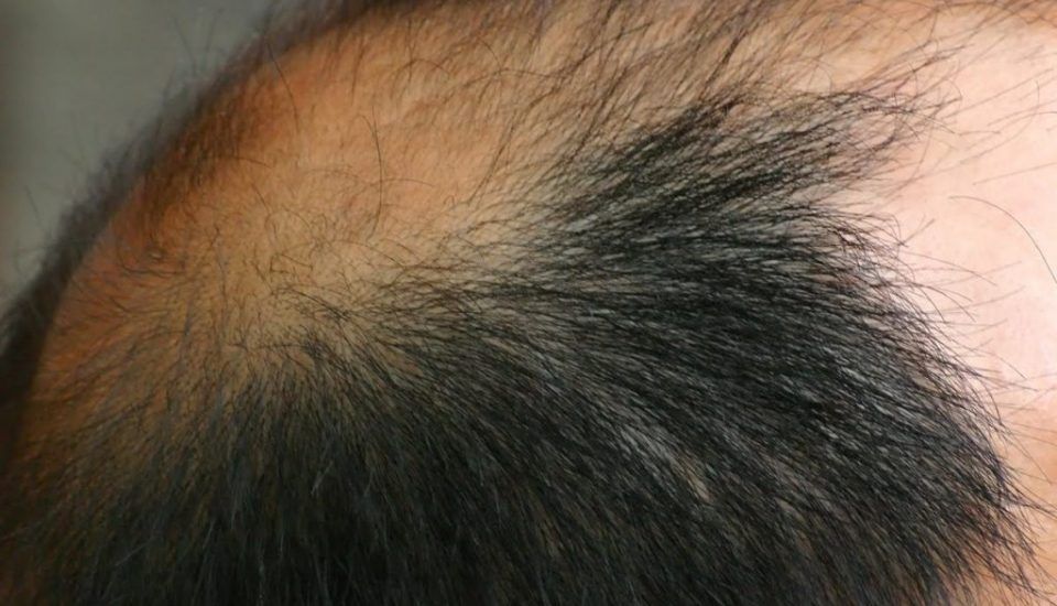 FUE-Haartransplantation