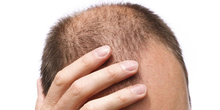 haartransplantation turkei