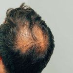 Mann vor der Haare wiederherstellen