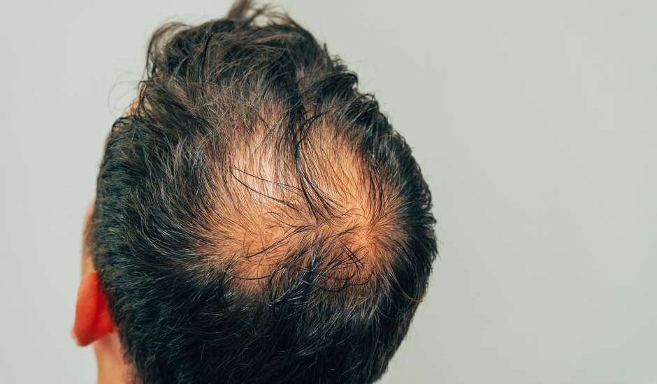 Mann vor der Haare wiederherstellen