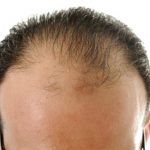 Haartransplantation und Stammzellenbehandlung