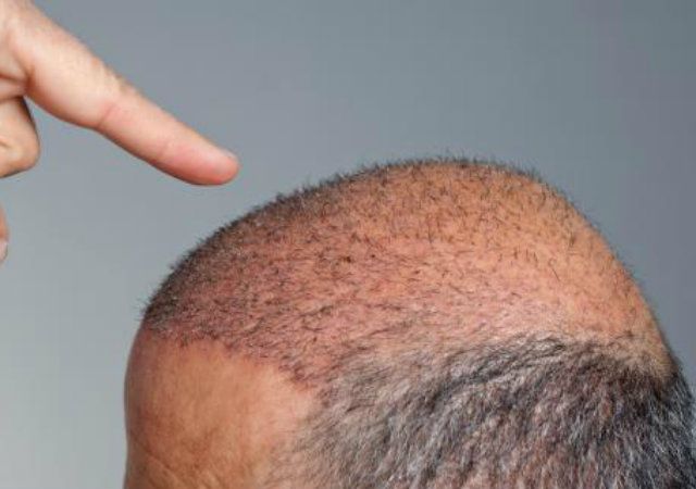 Haartransplantation für glatzköpfige Menschen
