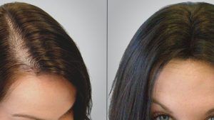 Graft de Hair Frau Truthahn