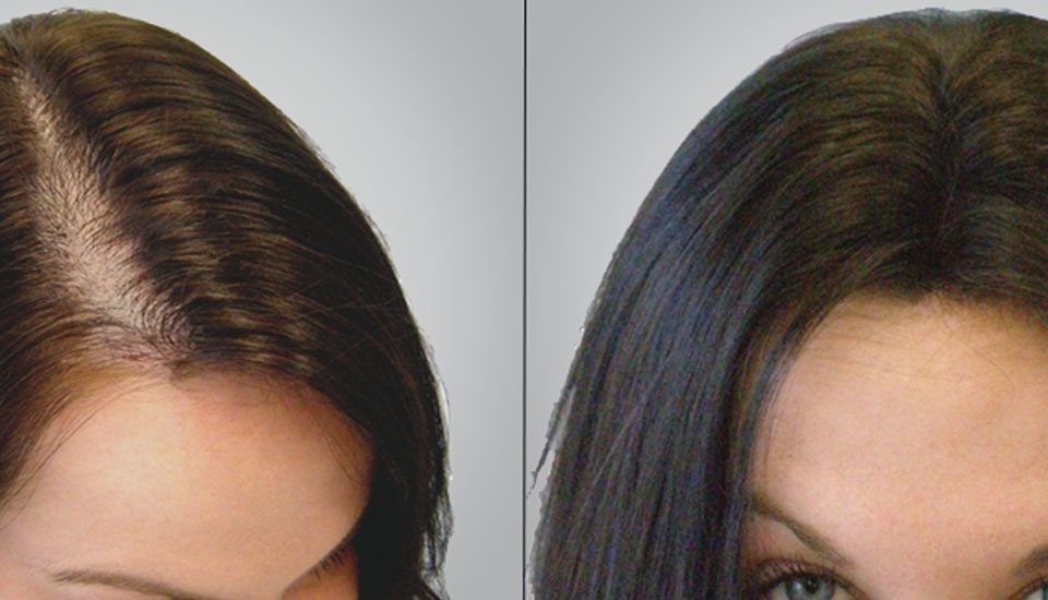 Graft de Hair Frau Truthahn