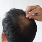 Haartransplantation kostet