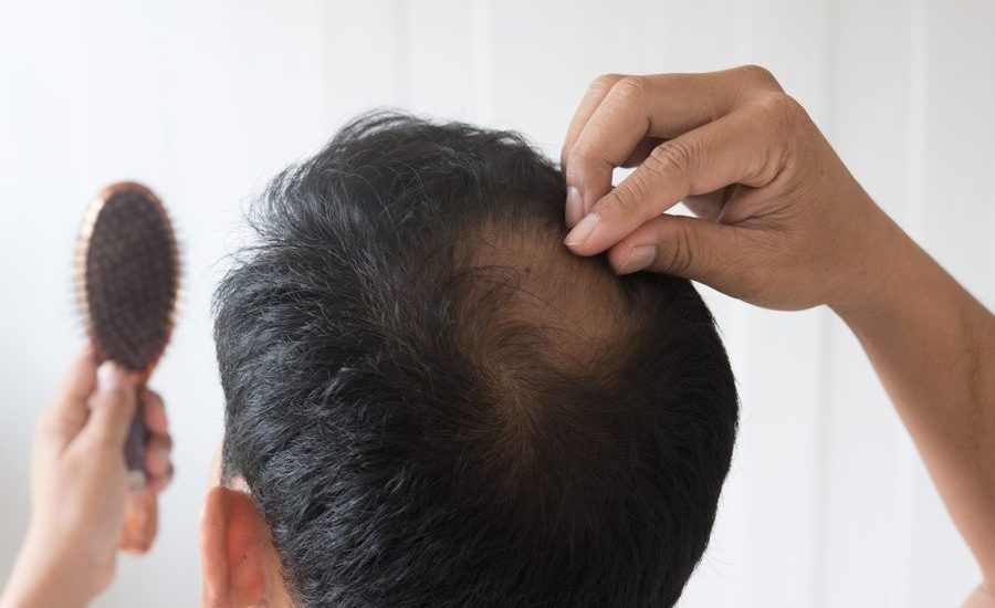 Haartransplantation kostet