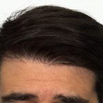 Haare nach haartransplantation wachsen