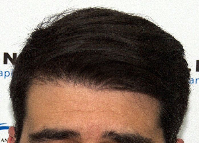 Haare nach haartransplantation wachsen