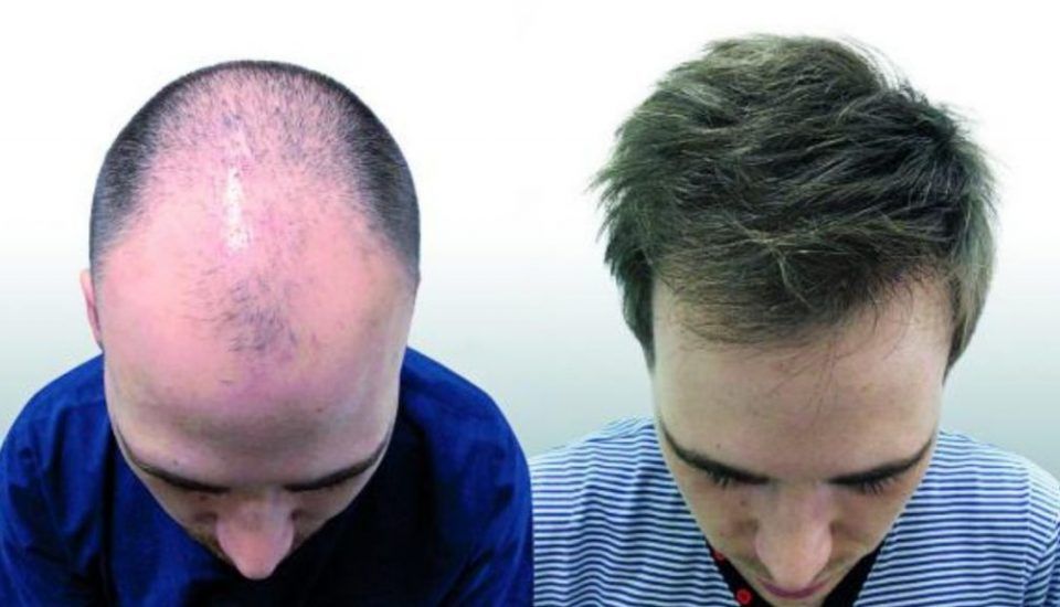 Mann vor und nach der Haartransplantation durchgeführt wird
