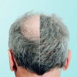 minoxidil