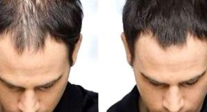 haartransplantation berlin