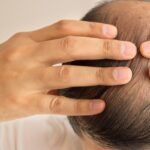 Haartransplantation Häufig gestellte Fragen
