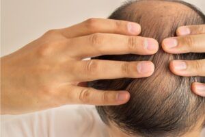 Haartransplantation Häufig gestellte Fragen