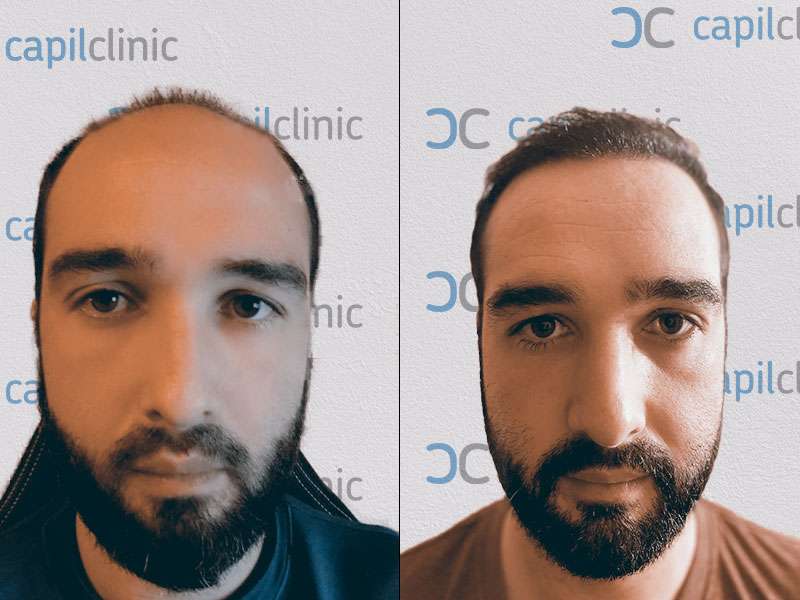 Ergebnis nach Haartransplantation