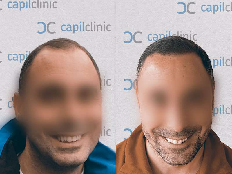 Ergebnis nach Haartransplantation