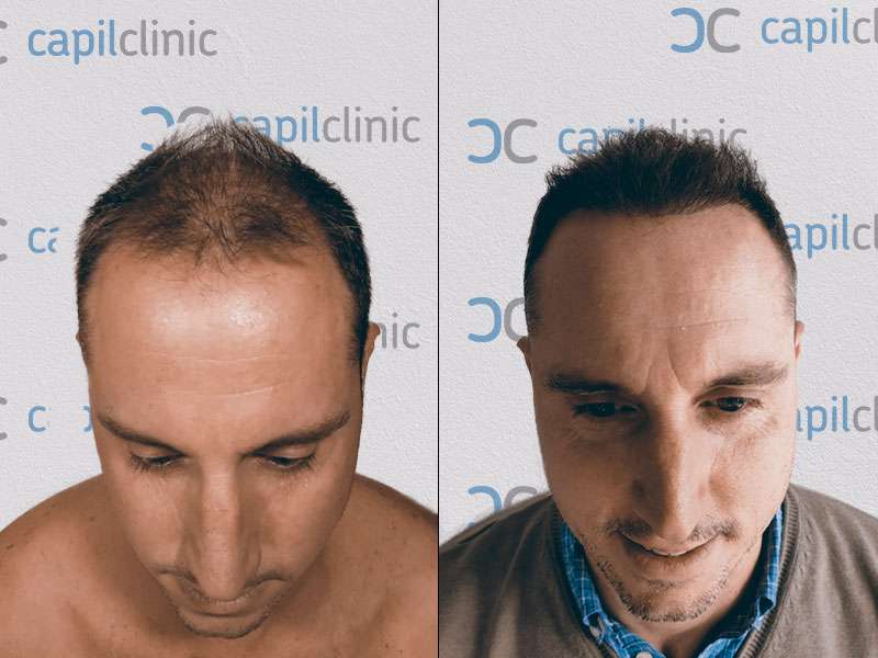 Ergebnis nach Haartransplantation