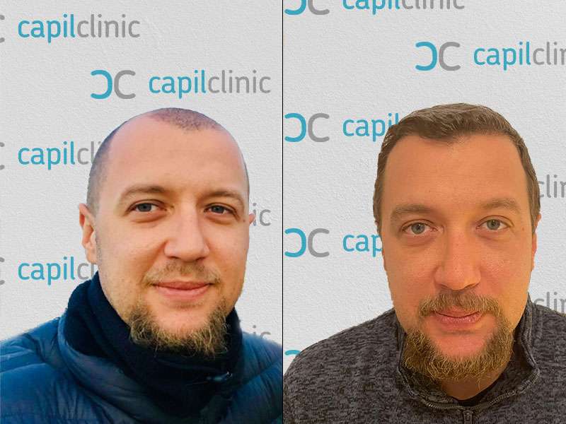 Ergebnis nach Haartransplantation