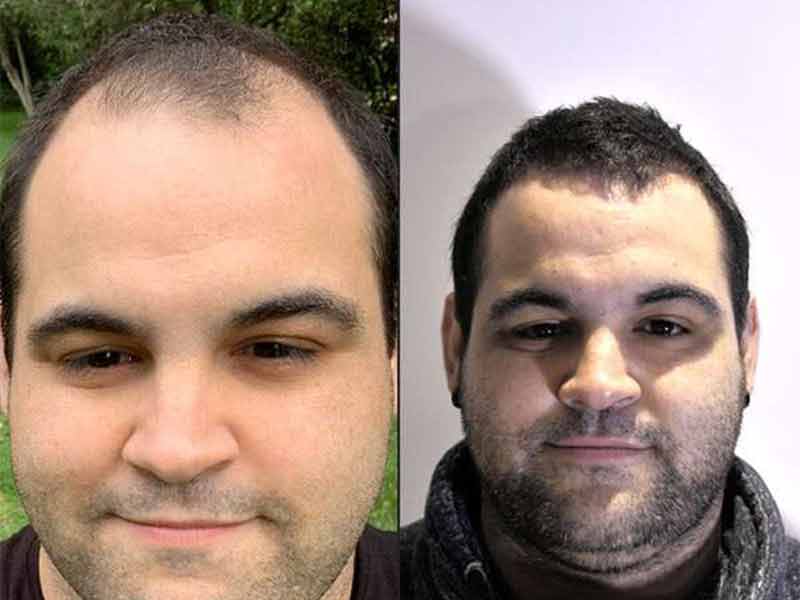 nach der haartransplantation madrid