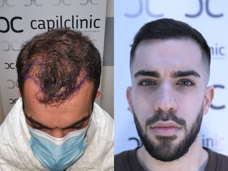 nach der haartransplantation madrid