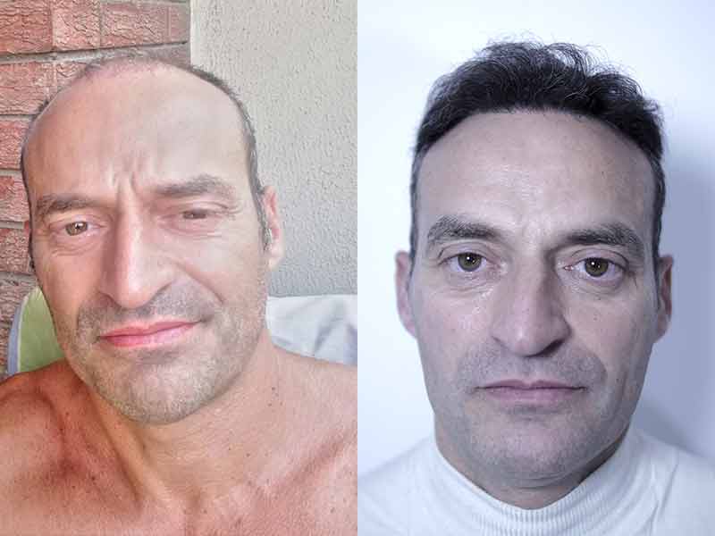 nach der haartransplantation Barcelone