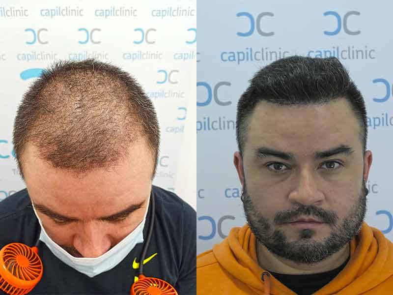 nach der haartransplantation Barcelona