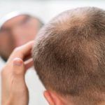 Ein Mann mit Minoxidil-Juckreiz