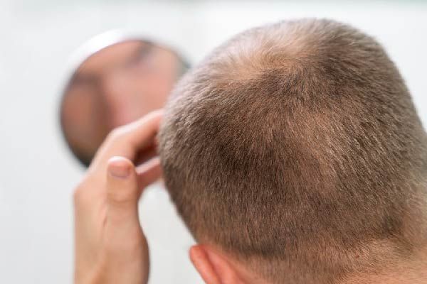 Ein Mann mit Minoxidil-Juckreiz