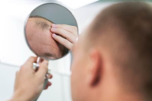 Diphencyprone: Eine Hoffnung im Kampf gegen Alopecia Areata
