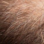 Haarausfall mit weißer Wurzel