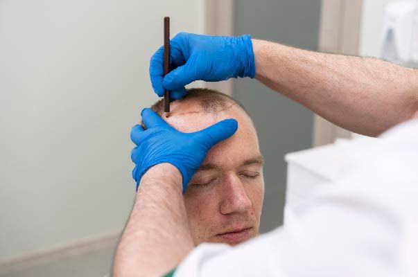 Was kostet eine Haartransplantation