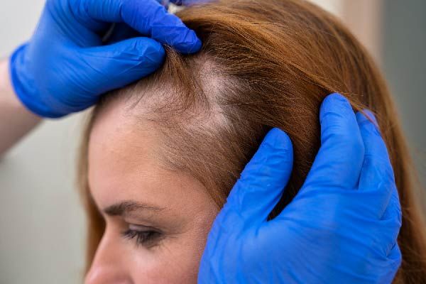 Jak-Hemmer für Alopecia areata